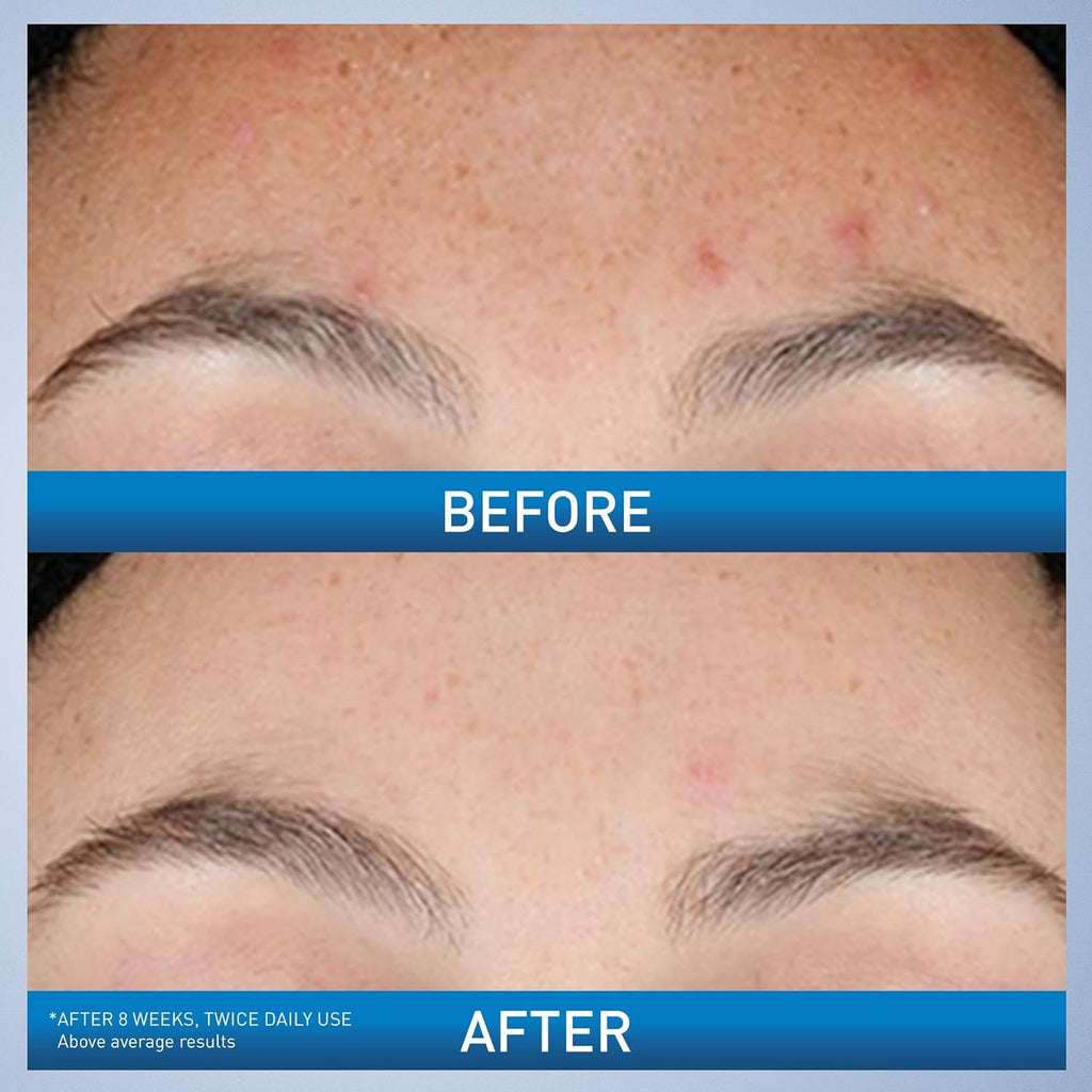CeraVe Resurfacing Retinol Serum For Post Acne Marks, Formulated With Licorice Root Extract & Niacinamide, Brightening Serum & Pore Minimizer For Face, Post Acne Skin Barrier Repair, Non-Comedogenic