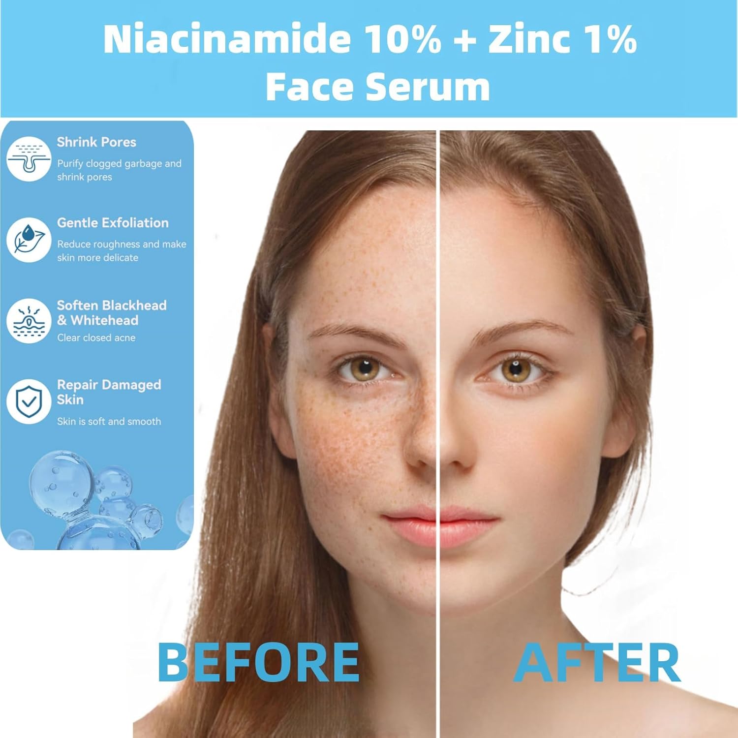 Niacinamide 10% + Zinc 1% Serum for Face – Oil Control, Acne, Pore Minimizer & Blemish Reduction – Lightweight, Non-Greasy Facial Serum, 30ml (1 Fl Oz) (1)