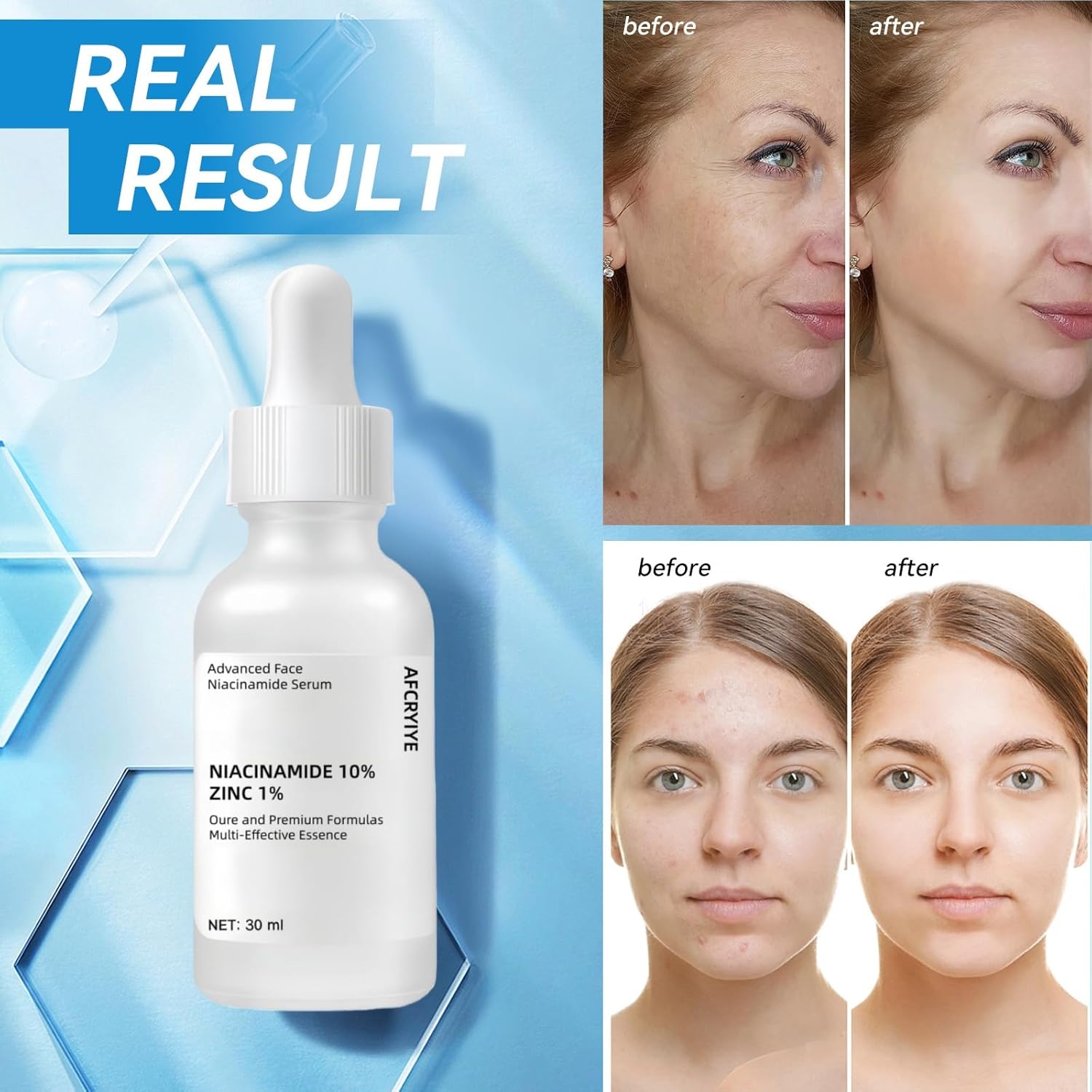 Niacinamide 10% + Zinc 1% Serum for Face – Oil Control, Acne, Pore Minimizer & Blemish Reduction – Lightweight, Non-Greasy Facial Serum, 30ml (1 Fl Oz) (1)