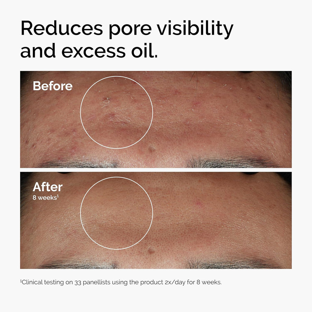 The Ordinary Serum Favorites Set – Hyaluronic Acid 2% + B5, Niacinamide 10% + Zinc 1%, Caffeine Solution 5% + EGCG Eye Serum, Serums for Hydrating, Brightening & Pore-Minimizing Skin Care